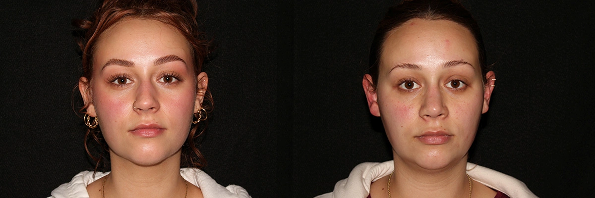 before and after front facing