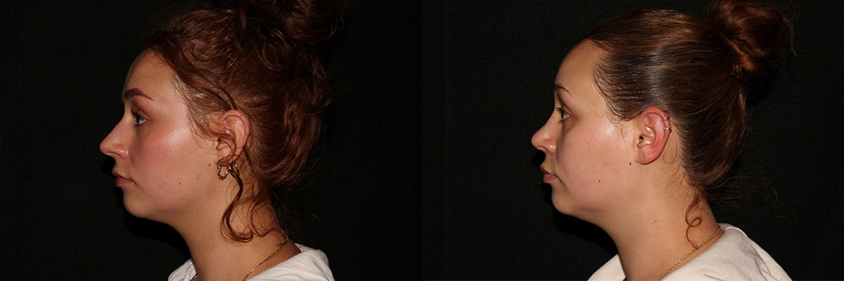 before and after side profile