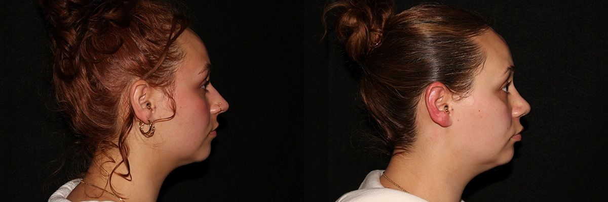 before and after side profile