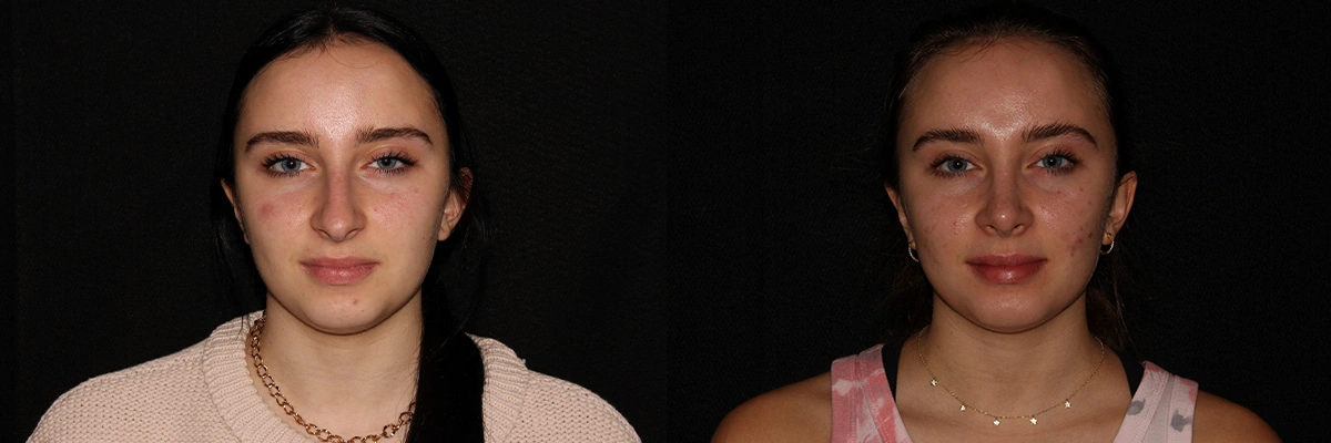 before and after forward facing